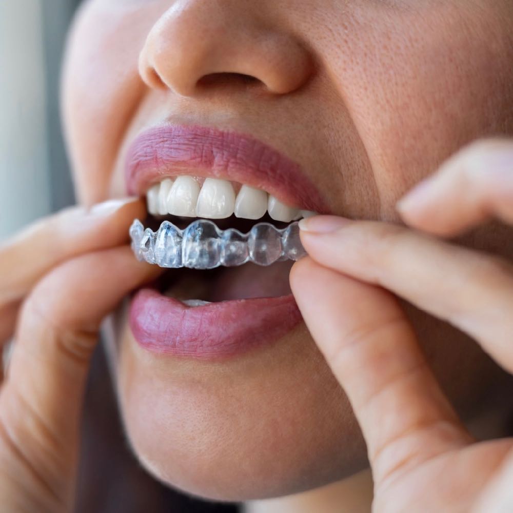 Invisalign - Sorriso