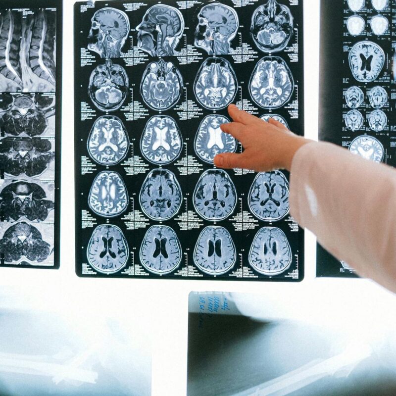 Neurochirurgia e Chirurgia Spinale