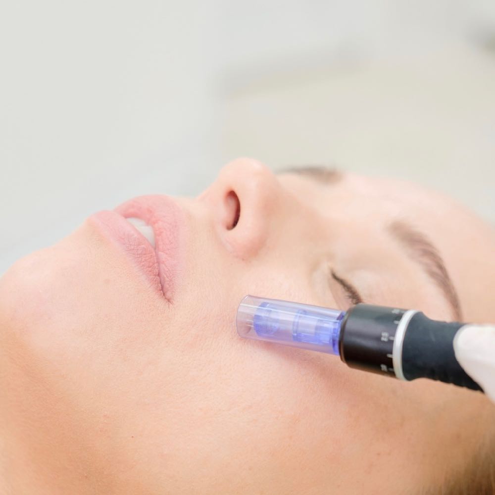 Microneedling Viso